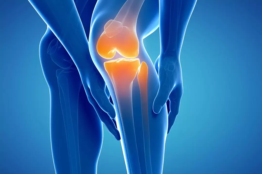 Artroza articulației genunchiului (gonartroză, osteoartrita deformatoare)