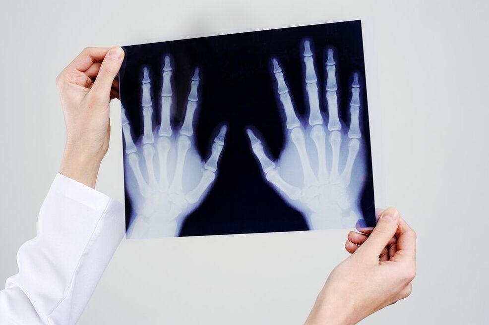 diagnosticarea articulației mâinii