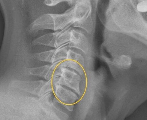 Osteochondroza coloanei vertebrale cervicale pe o rază X