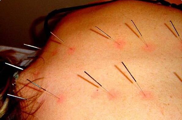 Acupunctura - o metodă de tratare a osteocondrozei cervicale